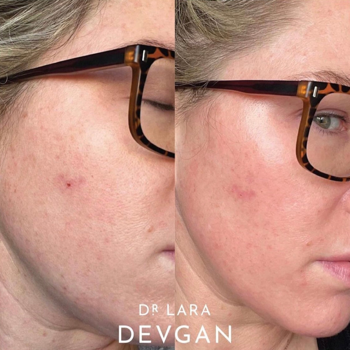 Dr. Devgan Vitamin C+B+E Ferulic Serum